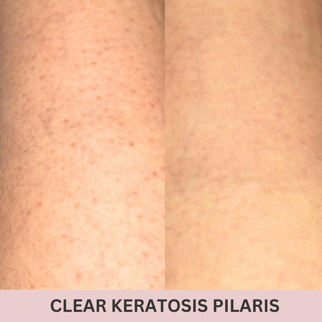 silky_hour_glove_before_and_after_clear_keratosis_pilaris.webp
